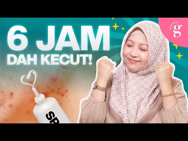 Nak Jerawat Cepat Kecut? Ini 5 Produk Terbaik 2025 Yang Wajib Cuba! (Review 2025)