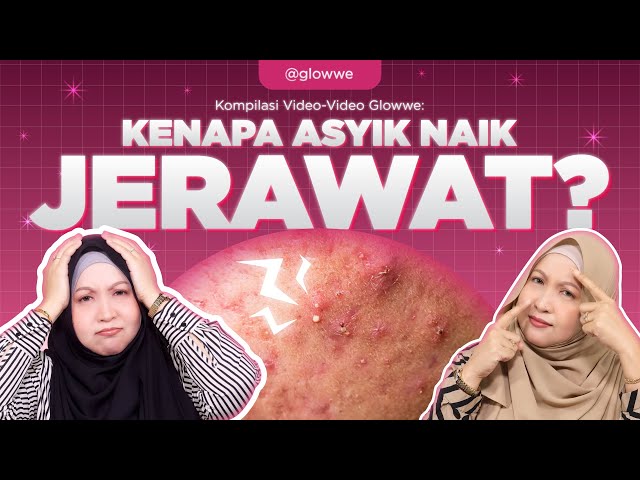 Punca Jerawat Dan Cara Atasinya Dengan Selamat Dan Berkesan