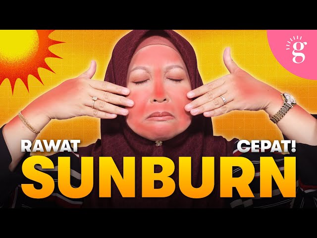 Kulit Muka Sunburn? Ini Langkah Demi Langkah Untuk Merawatnya 🌞