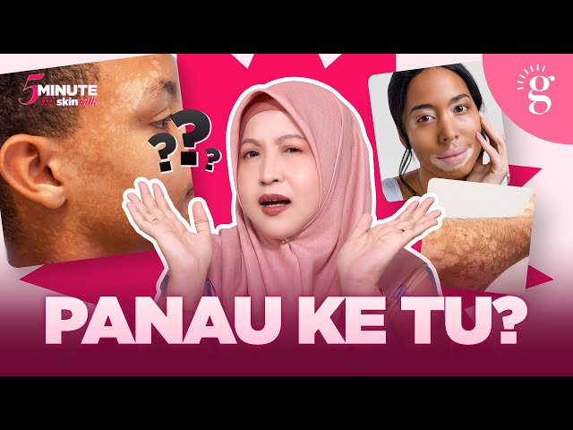 Kulit Mula Timbul Tompok Putih? Adakah Panau? Ini Punca Dan Cara Rawat Yang Betul