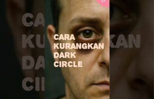 Bolehkah dark circle dihilangkan? Apakah caranya?