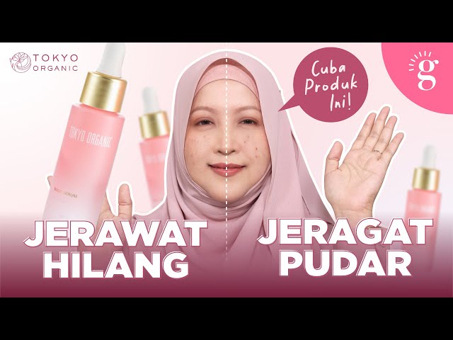 Bahan Ini Bantu Pudarkan Jeragat Dan Pulihkan Jerawat Secara Berkesan