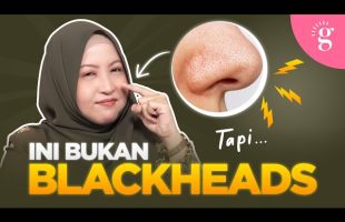 Bolehkah Sebaceous Filament Dihilangkan? Ini Cara Betul Untuk Atasinya