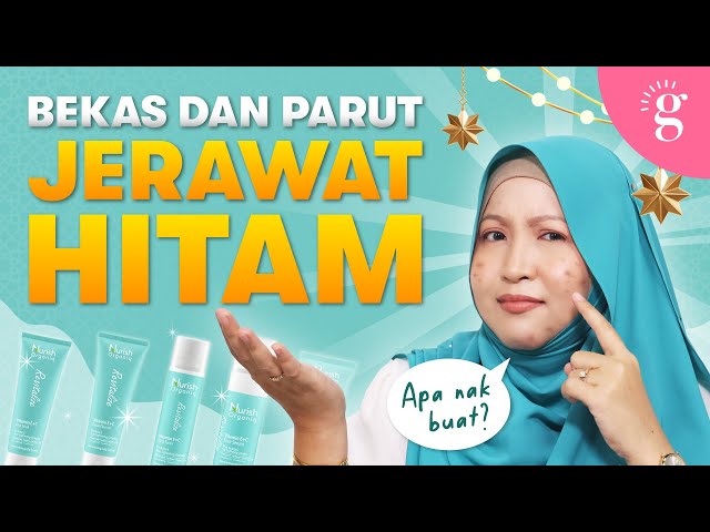 Cara Hilangkan Bekas Dan Parut Jerawat Hitam Dengan Pantas | Review Nurish Organiq Revitalize Series