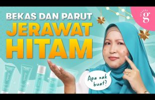 Cara Hilangkan Bekas Dan Parut Jerawat Hitam Dengan Pantas | Review Nurish Organiq Revitalize Series