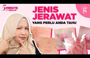 Blackheads vs Whiteheads, Papule vs Pustule, Nodule vs Cyst | Cara Hilangkan Semua Jenis Jerawat Ini