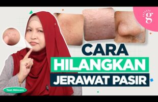 Cara Hilangkan Jerawat Pasir Untuk Remaja