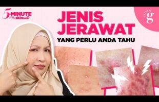Blackheads vs Whiteheads, Papule vs Pustule, Nodule vs Cyst | Cara Hilangkan Semua Jenis Jerawat Ini