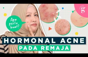 Punca Jerawat Hormon Di Kalangan Remaja Dan Cara Terbaik Untuk Atasinya