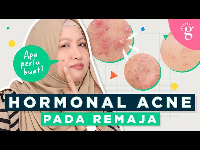 Punca Jerawat Hormon Di Kalangan Remaja Dan Cara Terbaik Untuk Atasinya