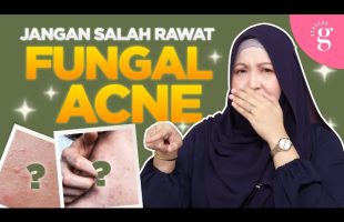 Cara Rawat Fungal Acne Dengan Betul Dan Selamat