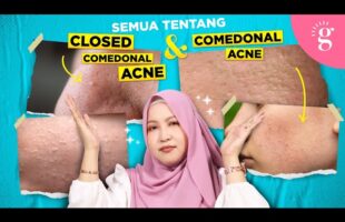 Kompilasi Video-Video Glowwe 2: Whiteheads Atau Closed Comedones