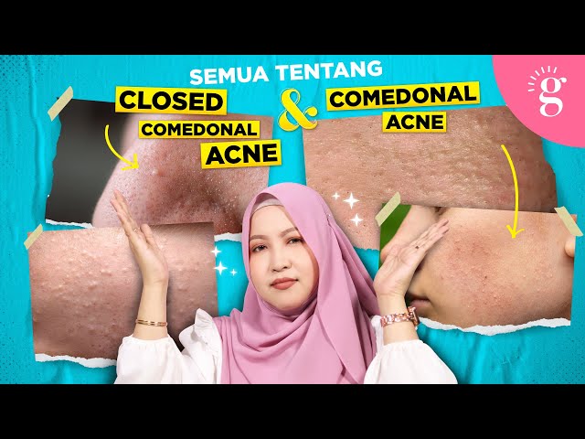 Kompilasi Video-Video Glowwe 2: Whiteheads Atau Closed Comedones