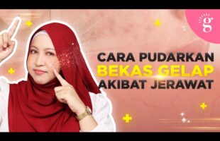 Cara Pudarkan Bekas Gelap Akibat Jerawat