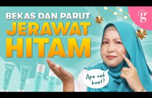 Cara Hilangkan Bekas Dan Parut Jerawat Hitam Dengan Pantas | Review Nurish Organiq Revitalize Series