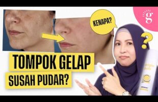 Cara Memudarkan Tompok Gelap pada Muka dan Badan
