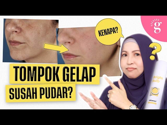 Cara Memudarkan Tompok Gelap pada Muka dan Badan
